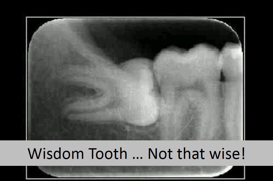 dental wisdom tooth vancouver emergencies mouth sores kare fall