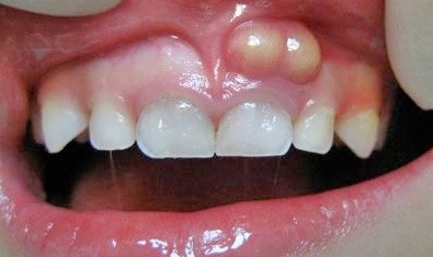 Dental Fistula Diagram