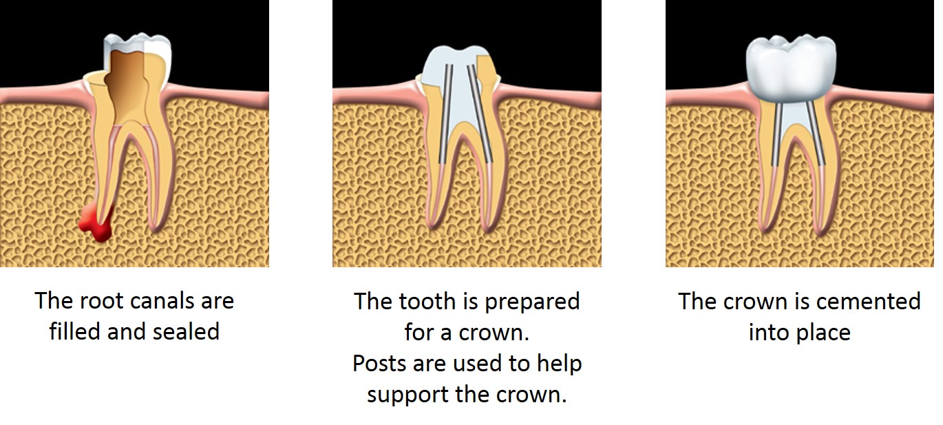 Root Canal Treatment Vancouver - Kare Dental