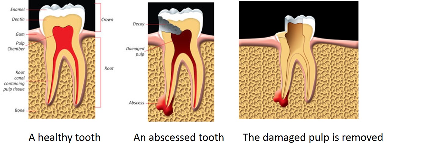 Root Canal Treatment Vancouver - Kare Dental